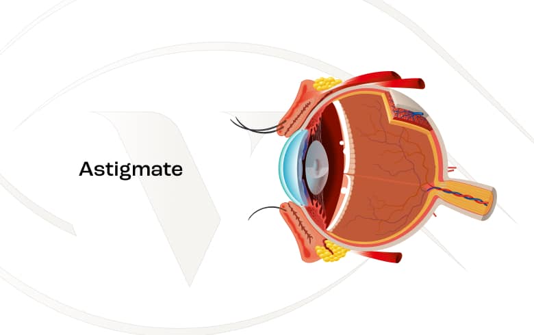 Pourquoi devient-on astigmate ?