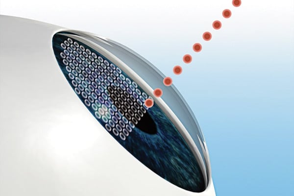 smile laser vision correction chirurgiens ophtalmologues chirurgie refractive oeil cataracte institut laser ophtalmologique voltaire paris